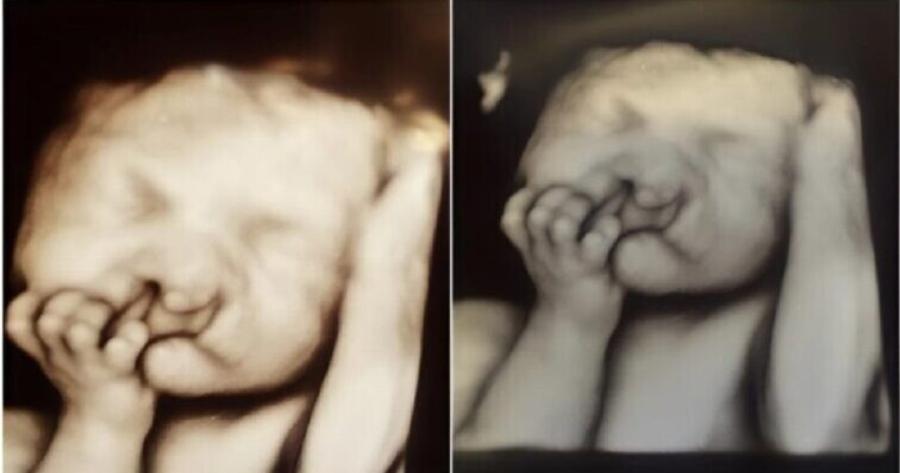 Έπαθαν σοκ όταν είδαν τις πρώτες εικόνες υπερήχων του παιδιού… Το μωρό γεννήθηκε με μια χαρακτηριστική μύτη και χείλη. Δείτε πώς μοιάζει τώρα.