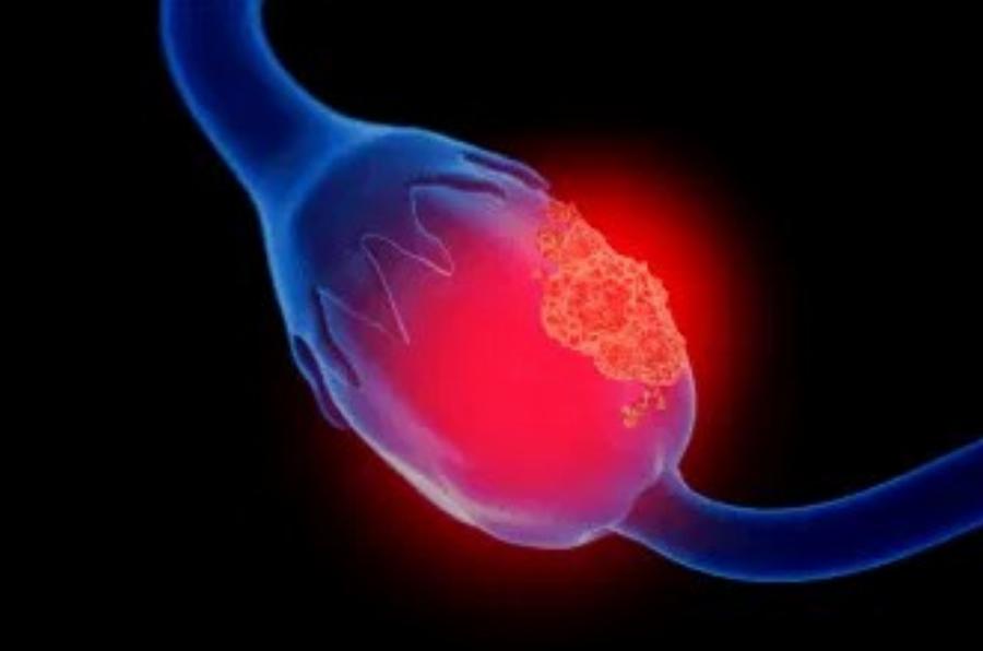 Η σχέση μεταξύ Kαpκivou των ωοθηκών και του μαστού: Τι πρέπει να γνωρίζει κάθε γυναίκα