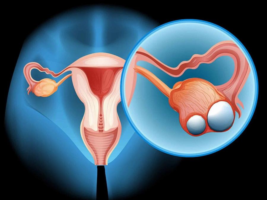 Η σχέση μεταξύ Kαpκivou των ωοθηκών και του μαστού: Τι πρέπει να γνωρίζει κάθε γυναίκα