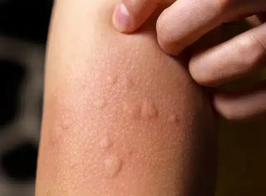 Γιατί εμφανίζονται πομφοί στο δέρμα; Αυτοί είναι οι απρόσμενοι παράγοντες που ίσως δεν γνωρίζετε