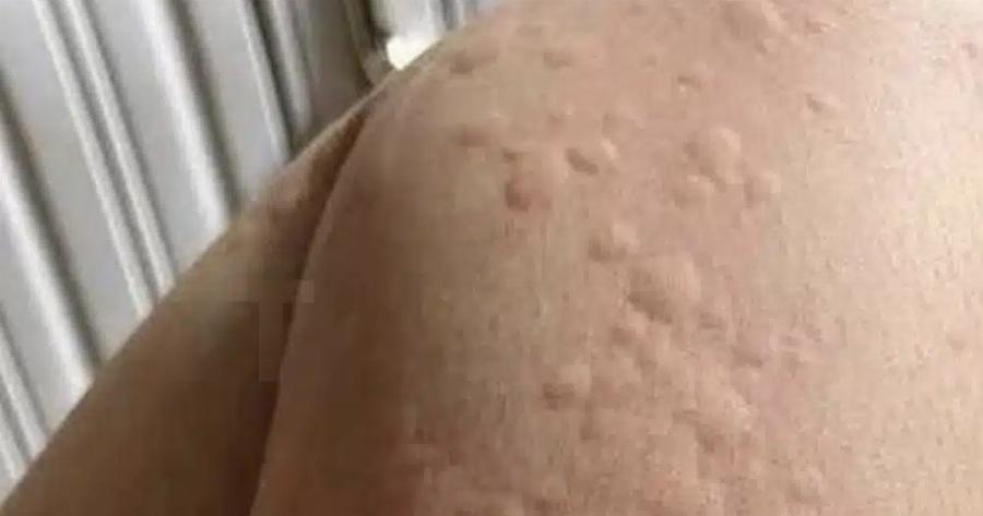 Γιατί εμφανίζονται πομφοί στο δέρμα; Αυτοί είναι οι απρόσμενοι παράγοντες που ίσως δεν γνωρίζετε