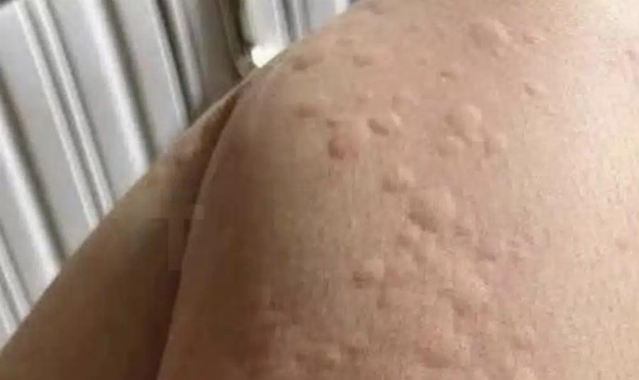 Γιατί εμφανίζονται πομφοί στο δέρμα; Αυτοί είναι οι απρόσμενοι παράγοντες που ίσως δεν γνωρίζετε