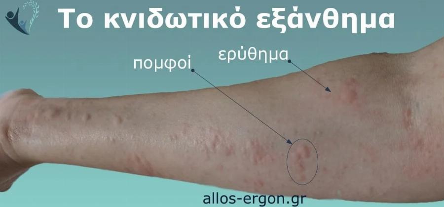 Γιατί εμφανίζονται πομφοί στο δέρμα; Αυτοί είναι οι απρόσμενοι παράγοντες που ίσως δεν γνωρίζετε
