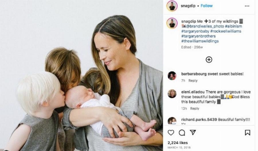 “Το μωρό κοροϊδευόταν για τα λευκά του μαλλιά”: Πώς μοιάζει τώρα;