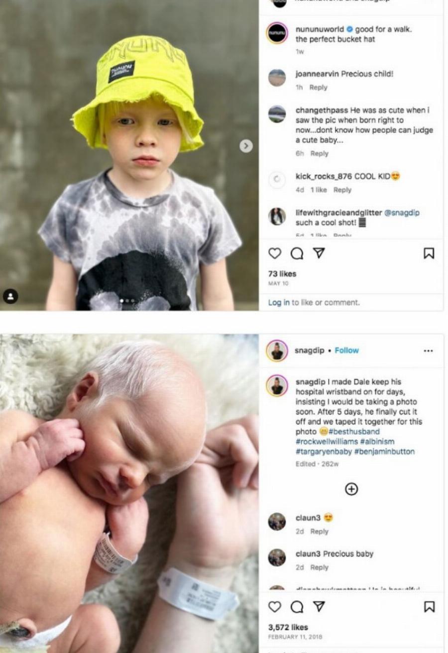 “Το μωρό κοροϊδευόταν για τα λευκά του μαλλιά”: Πώς μοιάζει τώρα;