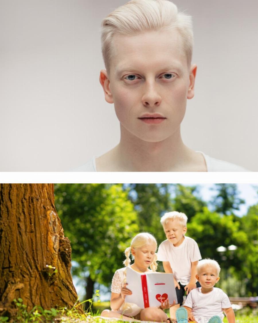 “Το μωρό κοροϊδευόταν για τα λευκά του μαλλιά”: Πώς μοιάζει τώρα;