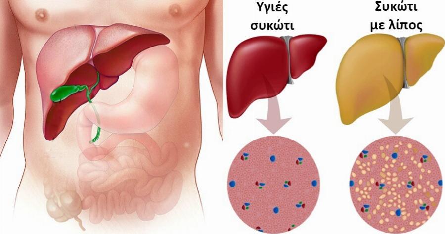 2 στους 5 Ανθρώπους έχουν Λίπος στο Συκώτι και Δεν το Γνωρίζουν. Ιδού 10 Φυσικοί Τρόποι για το Αποτοξινώσετε