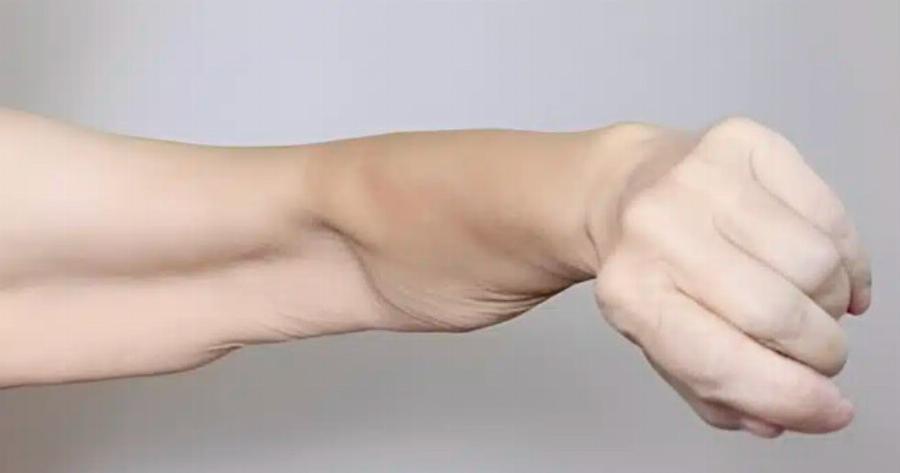 Σαρκοπενία: Αιτίες απώλειας μυϊκής μάζας και λύσεις