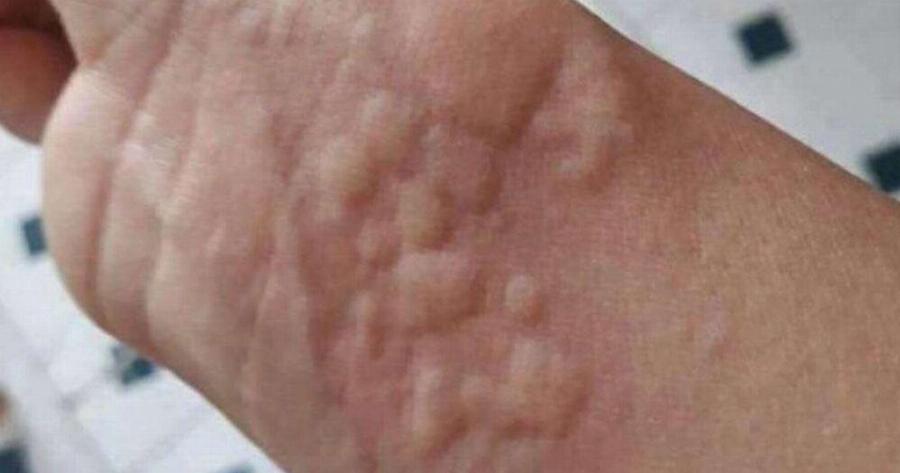 Οι γιατροί προειδοποιούν ότι αν δείτε αυτά τα σημάδια στο δέρμα…