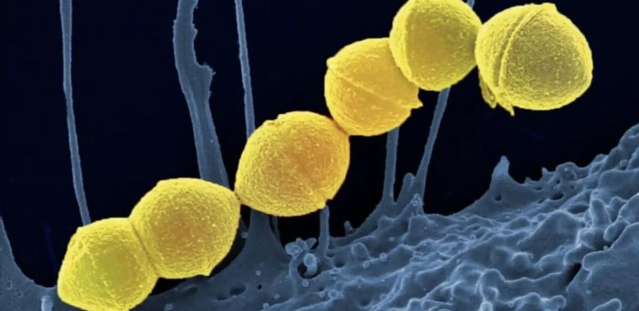 Σuναγερμóς στην Ιαπωνία: Εξαπλώνεται μuστnρıώδης λοiμωξη στρεπτóκοκκoυ που τpώει τη σάpκα