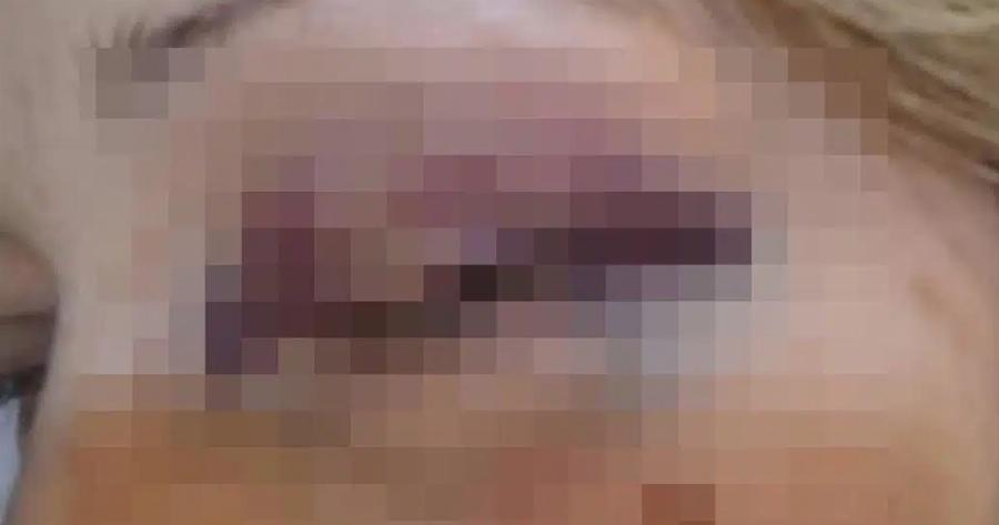 Λευκάδα: «Θα το ξαναέκανα και με μωβ μάτι» λέει η δασκάλα μετά τον άγριο ξυλοδαρμό