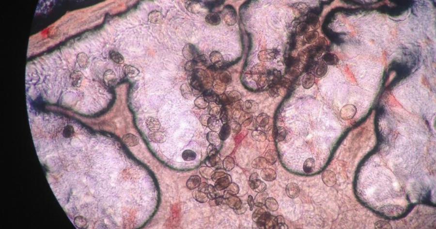 Τρόμος από παρασιτικό σκουλήκι: Προκαλεί καρκίνο και εισβάλλει στο σώμα… χωρίς να το καταλάβεις