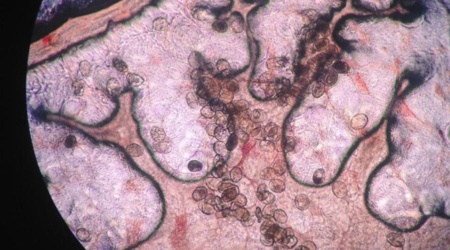 Τρόμος από παρασιτικό σκουλήκι: Προκαλεί καρκίνο και εισβάλλει στο σώμα… χωρίς να το καταλάβεις