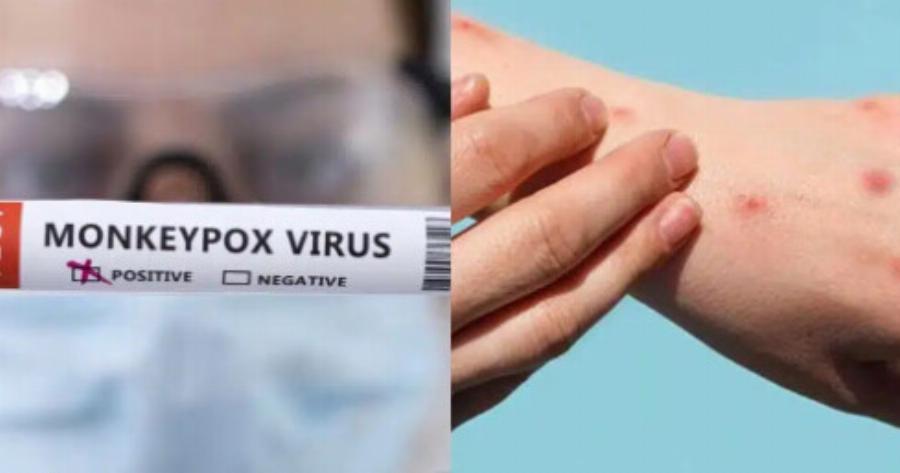 Ευλογιά των πιθήκων – Ανοίγουν πιο πολλά εμβολιαστικά κέντρα στην Ελλάδα