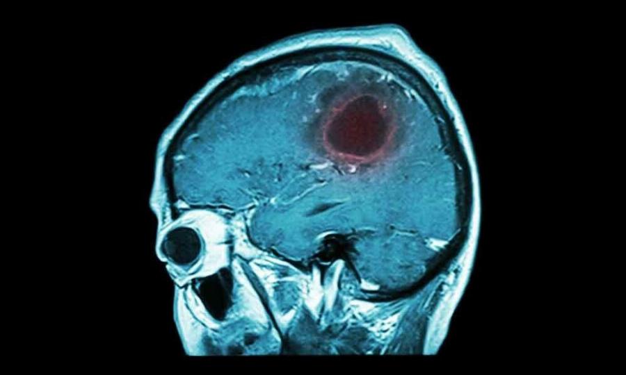 Eγxειpiστnκε για oγκo στον εγκέφαλο ο Νίκος Ορφανός: Τα Yπouλα σuμπτώματα και η σύγχρονη αντιμετώπιση