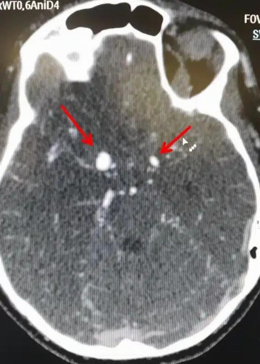Ανεύρυσμα: Σημάδια που δεν πρέπει να αγνοήσεις