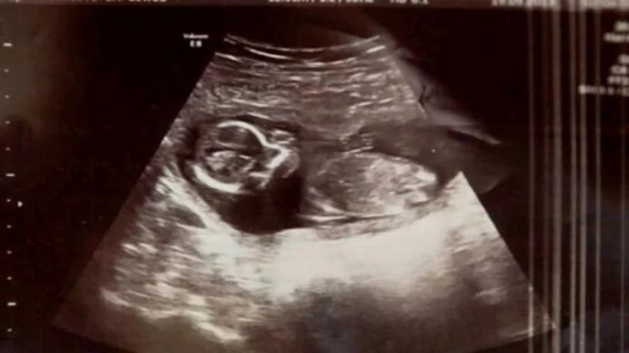 31χρονη δέκα μέρες μετά την έκτρωση πήγε στο γιατρό για εξετάσεις – Σοκαρισμένοι δεν πίστευαν ότι το μωρό