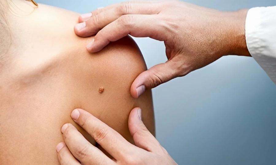 Γιατί εμφανίζονται σαρκώδεις ελιές στο λαιμό ή στις μασχάλες μου και πώς μπορώ να τις αφαιρέσω; Οι ειδικοί εξηγούν