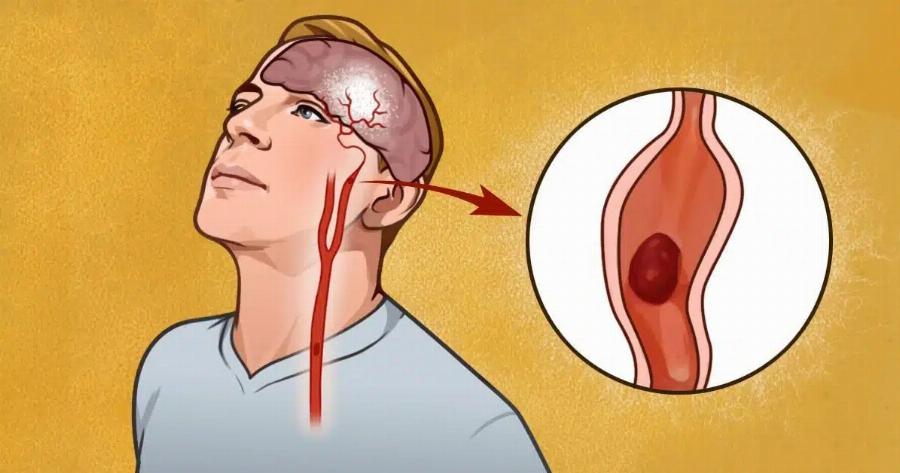 Όποιος κάνει αυτά τα 4 πράγματα μειώνει κατά 80% την πιθανότητα για εγκεφαλικό: Θυμηθείτε τα αρχικά ΑΠΧΚ!