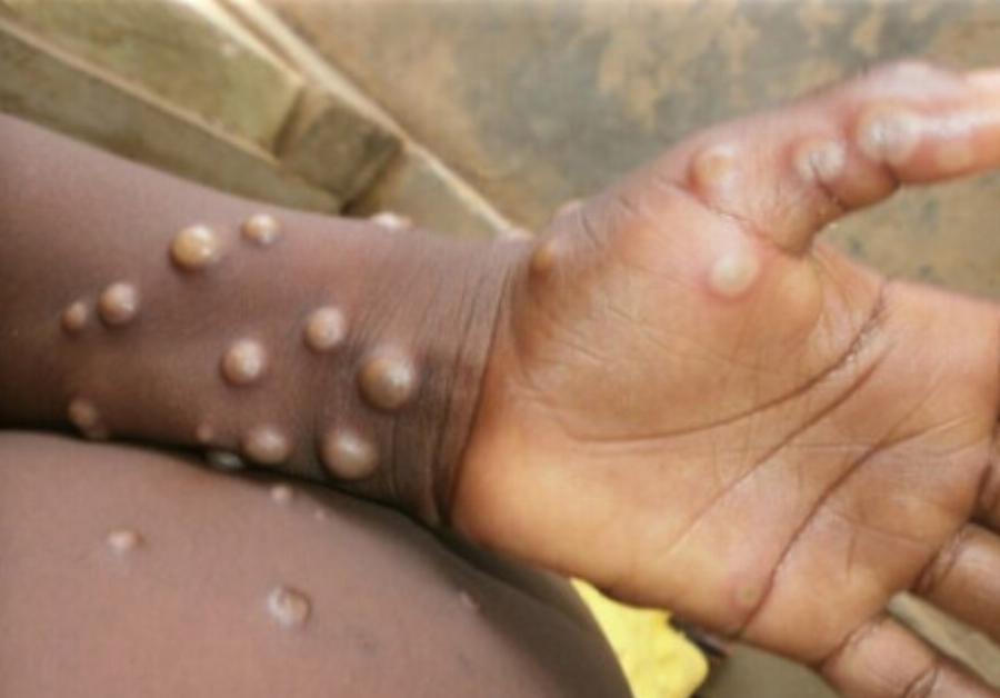 EKTAKTO Συναγερμός για την νέα πανδημία – Αρχίζουν οι εμβολιασμοί στην Ελλάδα