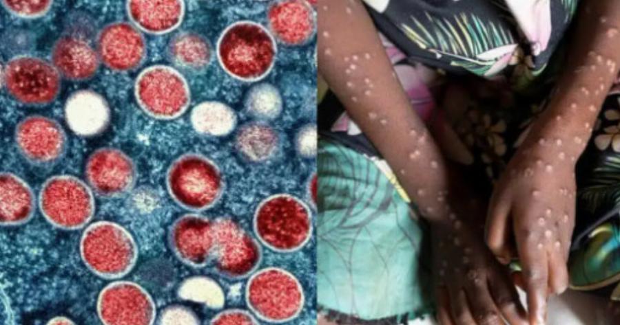 EKTAKTO Συναγερμός για την νέα πανδημία – Αρχίζουν οι εμβολιασμοί στην Ελλάδα