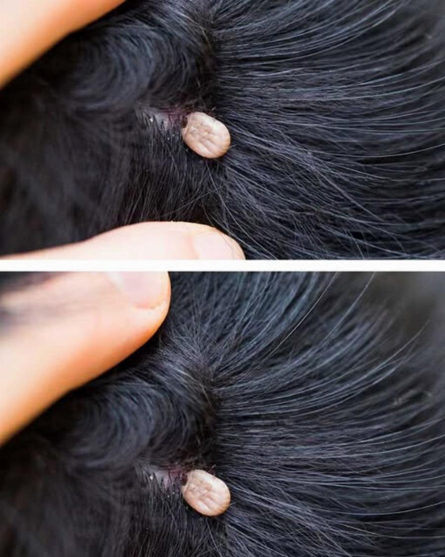 Μόλις ανακάλυψα αυτό στα μαλλιά του γιου μου. Τι είναι αυτό; Δεν είμαι σίγουρη αν πρέπει να πάμε στο γιατρό