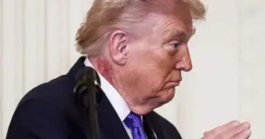 Παγκόσμια Ανησυχία για την υγεία του Ντόναλντ Τραμπ – Τι σημαίνει το εξάνθημα που έχει στο λαιμό του