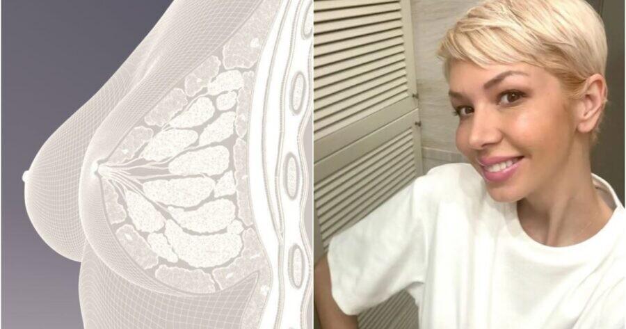 Τι είναι ο καρκίνος του μαστού από τον οποίο πέθανε η Αλεξάνδρα Νικολαΐδου