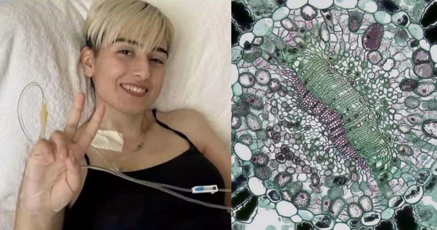 Τι είναι το σάρκωμα Ewing από το οποίο πeθανε η 21χρονη Ραφαέλα