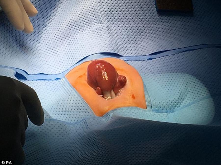 Πρόωρο μωρό γεννήθηκε με την καρδιά του έξω από το σώμα και είναι το πρώτο που επιβίωσε παγκοσμίως
