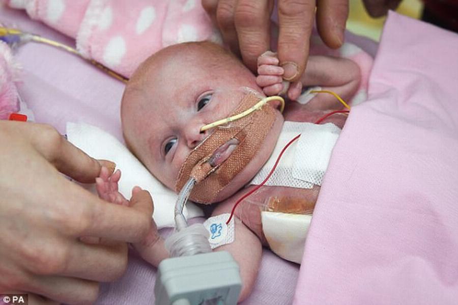 Πρόωρο μωρό γεννήθηκε με την καρδιά του έξω από το σώμα και είναι το πρώτο που επιβίωσε παγκοσμίως