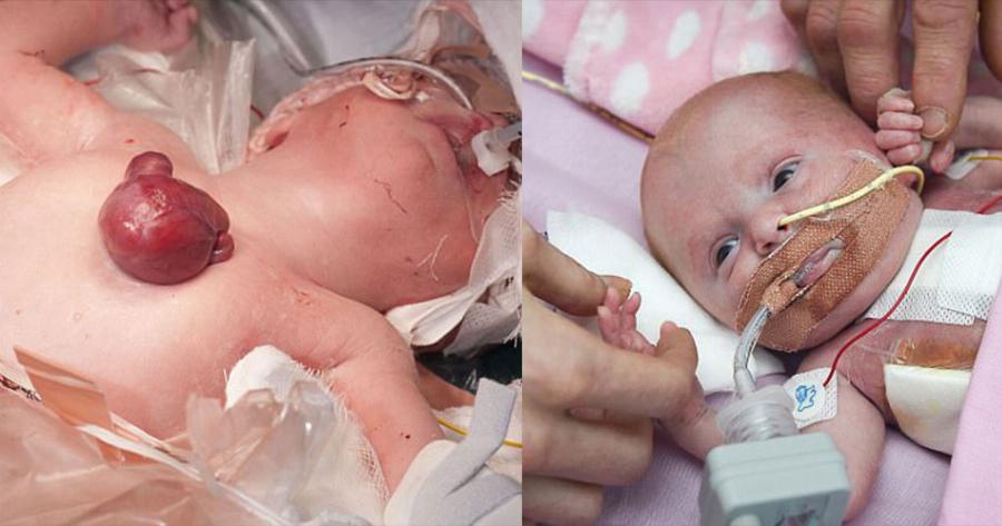 Πρόωρο μωρό γεννήθηκε με την καρδιά του έξω από το σώμα και είναι το πρώτο που επιβίωσε παγκοσμίως