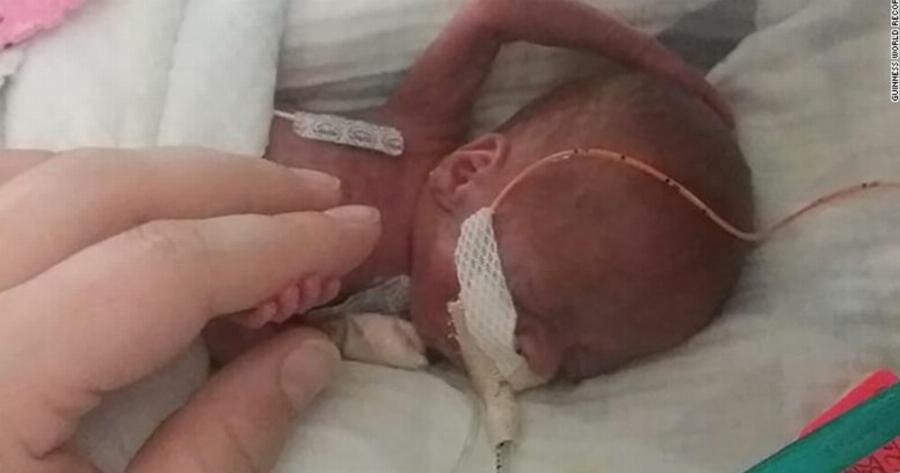 To «πιο πρόωρο μωρό του κόσμου» γιόρτασε τα πρώτα του γενέθλια – Είχε 0% πιθανότητα επιβίωσης