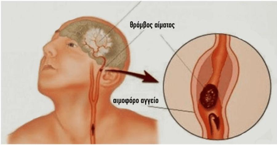Tι κάνουμε σε περίπτωση εγκεφαλικού; – Παίρνει μόνο 1 λεπτό για να το διαβάσετε