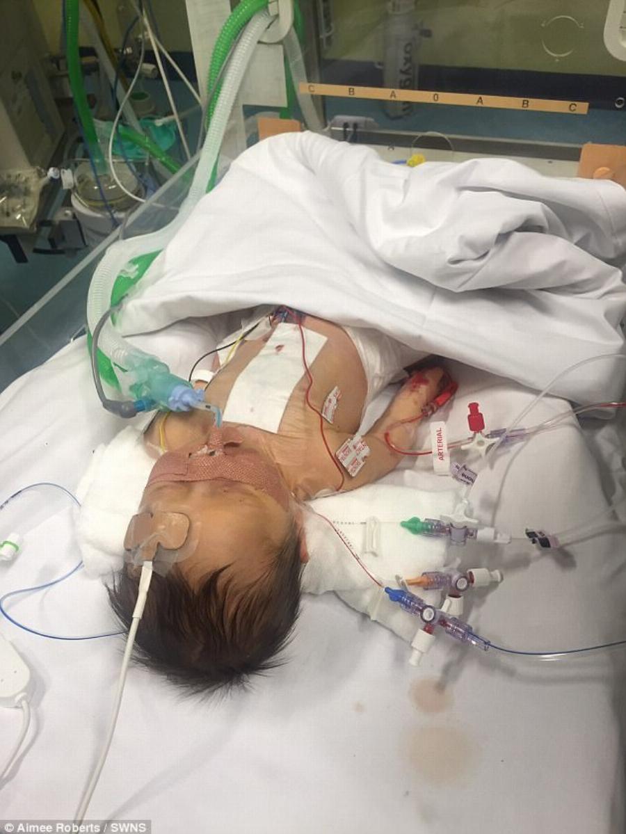 Βρέφος 7 Ημερών: Υποβλήθηκε σε εγχείρηση ανοιχτής καρδιάς και κέρδισε τη μάχη για τη ζωή παρά τις προβλέψεις των γιατρών