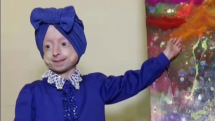 Πέθανε η 10χρονη Ιρίνα που είχε το σώμα 80χρονης – Το σύνδρομο «Μπέντζαμιν Μπάτον»