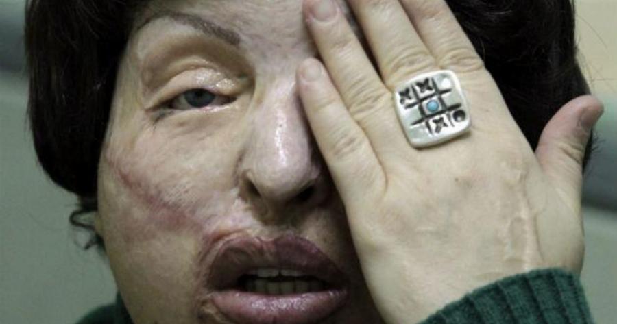 Μου έριξαν βιτριόλι επειδή είχα σχέση με παντρεμένο. Το έκανε η γυναίκα του με την κουμπάρα της – Η αληθινή ιστορία της κυρίας Άννας