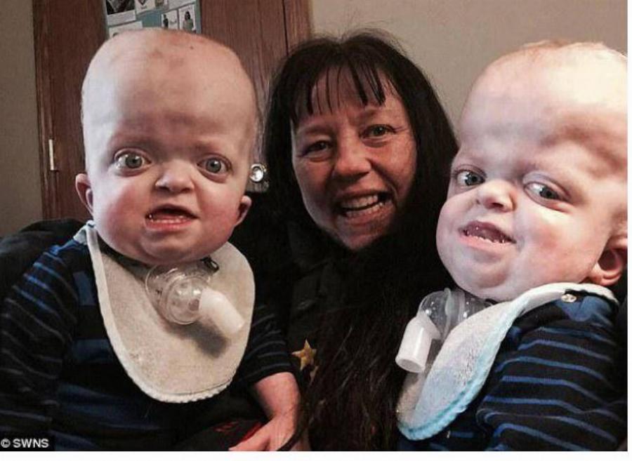 Γιαγιά 58 ετών υιοθετεί δίδυμα με σπάνια γενετική παραμόρφωση και αφιερώνει τη ζωή της ώστε να κάνει τη δική τους καλύτερη