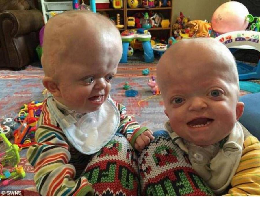 Γιαγιά 58 ετών υιοθετεί δίδυμα με σπάνια γενετική παραμόρφωση και αφιερώνει τη ζωή της ώστε να κάνει τη δική τους καλύτερη