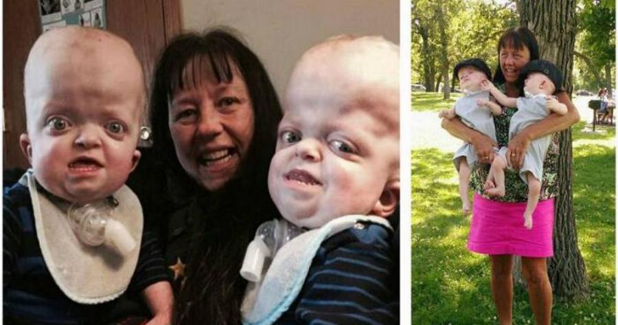 Γιαγιά 58 ετών υιοθετεί δίδυμα με σπάνια γενετική παραμόρφωση και αφιερώνει τη ζωή της ώστε να κάνει τη δική τους καλύτερη