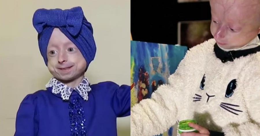 Πέθανε η 10χρονη Ιρίνα που είχε το σώμα 80χρονης – Το σύνδρομο «Μπέντζαμιν Μπάτον»