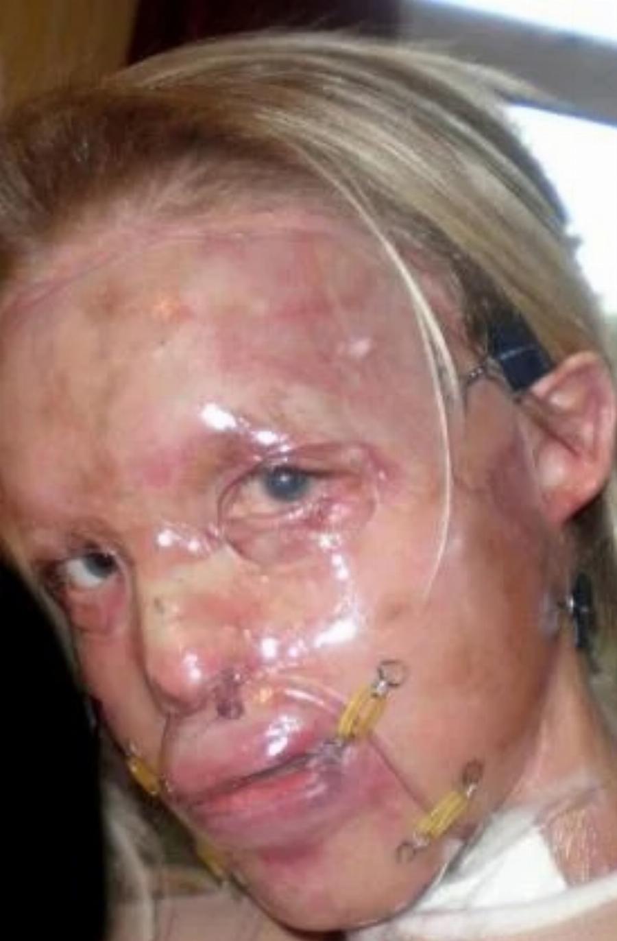 Αληθινή ηρωίδα: Της έριξαν βιτριόλι στο πρόσωπο, την κακοποίησαν,  και σήμερα είναι γνωστή παρουσιάστρια στην τηλεόραση