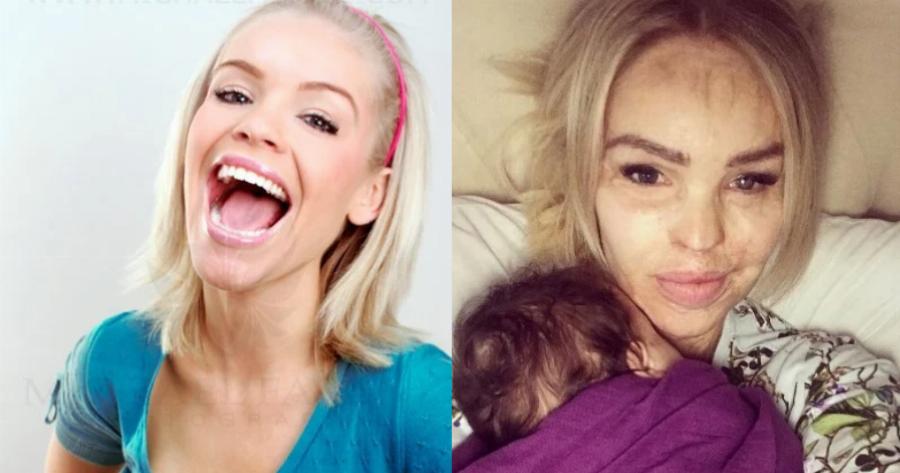 Αληθινή ηρωίδα: Της έριξαν βιτριόλι στο πρόσωπο, την κακοποίησαν,  και σήμερα είναι γνωστή παρουσιάστρια στην τηλεόραση