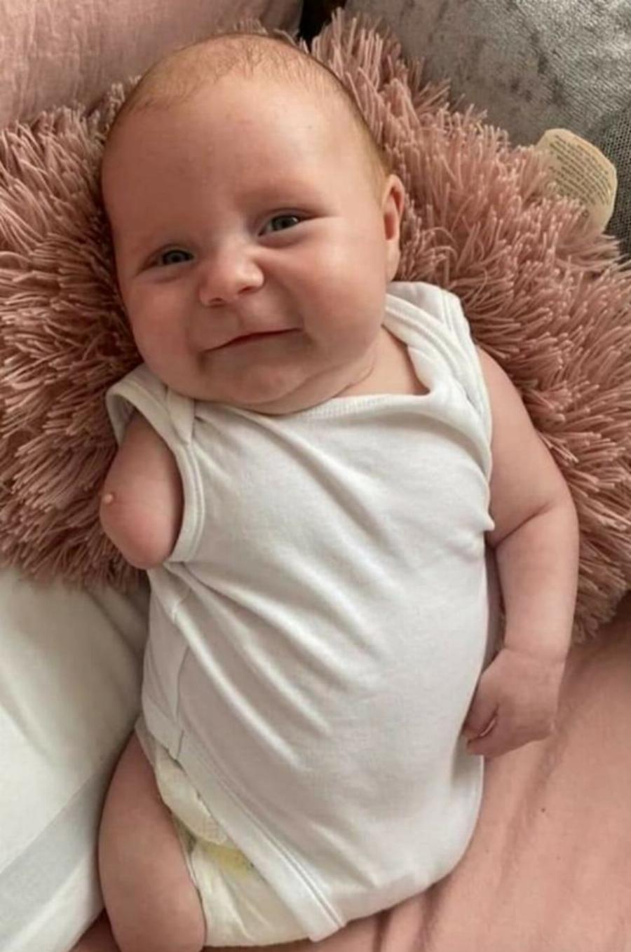 Μητέρα γνώριζε ότι θα γεννήσει παιδί χωρίς χέρι και πόδια και το κράτησε – Αρνήθηκε να αποβάλει το μωρό της