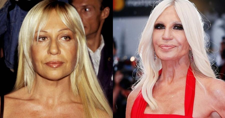 Έκαναν εγχειρήσεις αλλά τις μετάνιωσαν: 10 διάσημες που παραμορφώθηκαν από τις πλαστικές επεμβάσεις