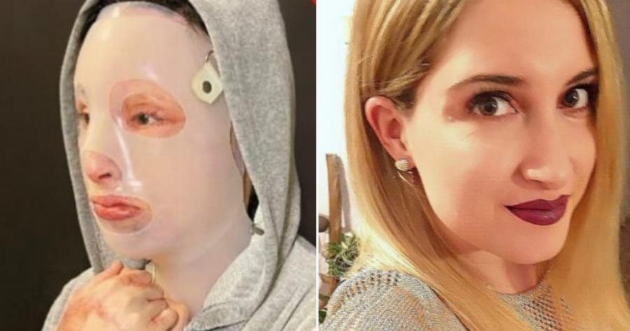 Εικόνα που κόβει την ανάσα: Η 35χρονη Ιωάννα αποκαλύπτει το πρόσωπο της μετά την επίθεση με το βιτριόλι
