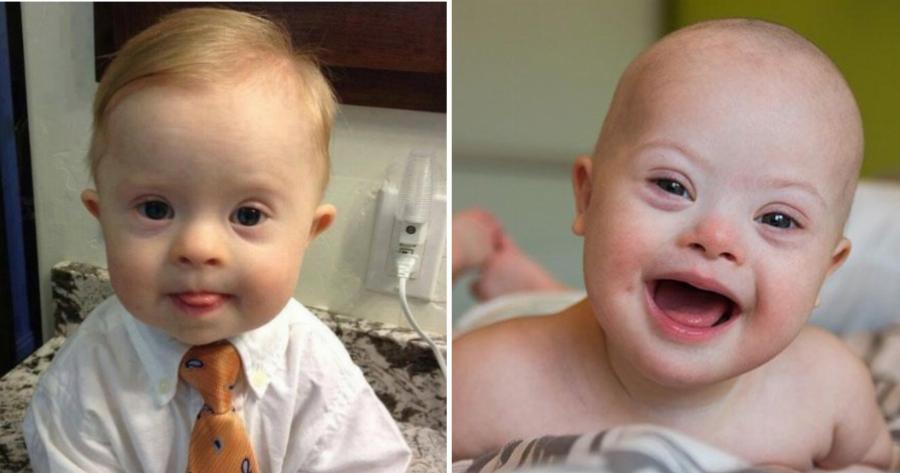 Να αγκαλιάζεις σφιχτά το παιδί με το ένα χρωμόσωμα παραπάνω