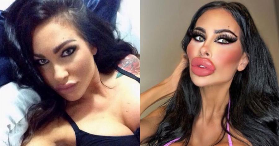 Νοσοκόμα 31 ετών εθισμένη στις πλαστικές: Γυρίζει τον κόσμο κάνοντας επεμβάσεις στο σώμα της