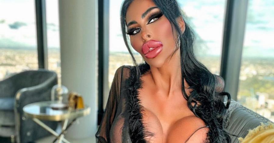 Νοσοκόμα 31 ετών εθισμένη στις πλαστικές: Γυρίζει τον κόσμο κάνοντας επεμβάσεις στο σώμα της