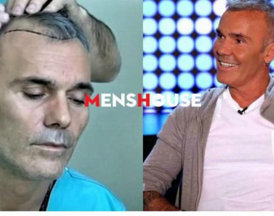 Οι 5 διάσημοι Έλληνες που τόλμησαν να κάνουν εμφύτευση μαλλιών